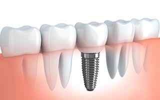 Tooth Whitening