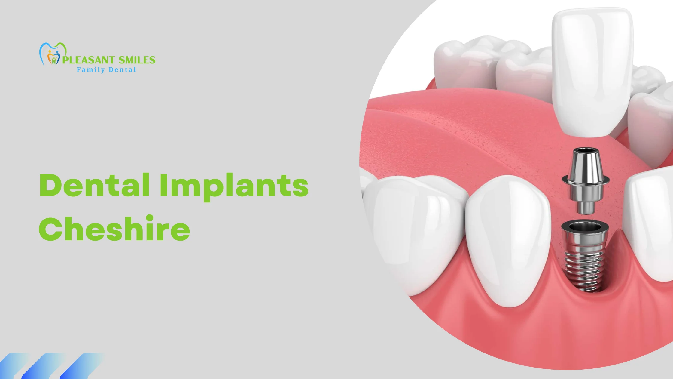 Dental Implants Cheshire