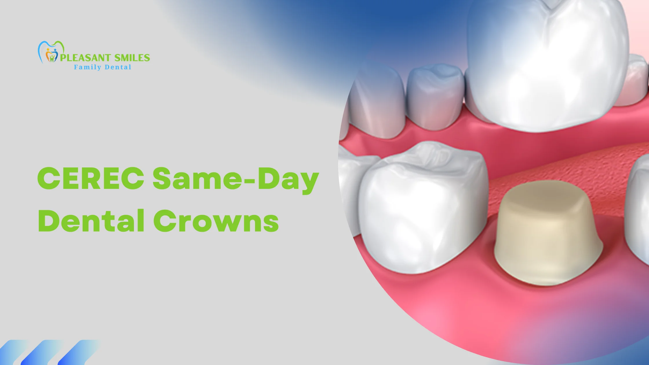 Same Day Crowns: CEREC Same-Day Dental Crowns