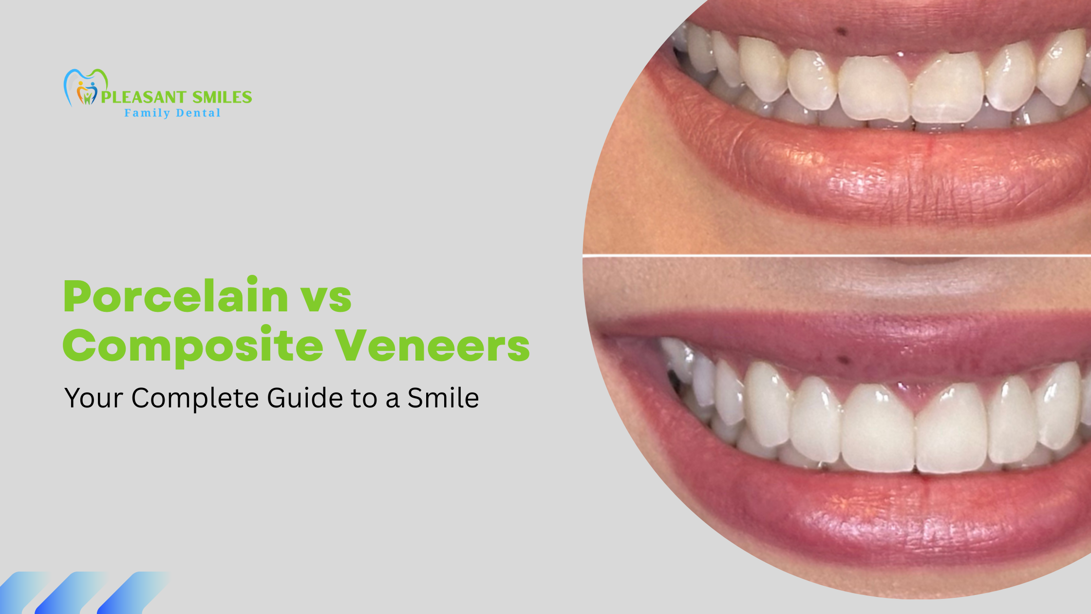 Porcelain vs Composite Veneers
