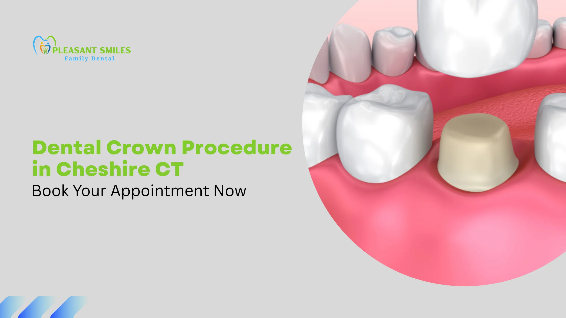 Dental Crown Procedure