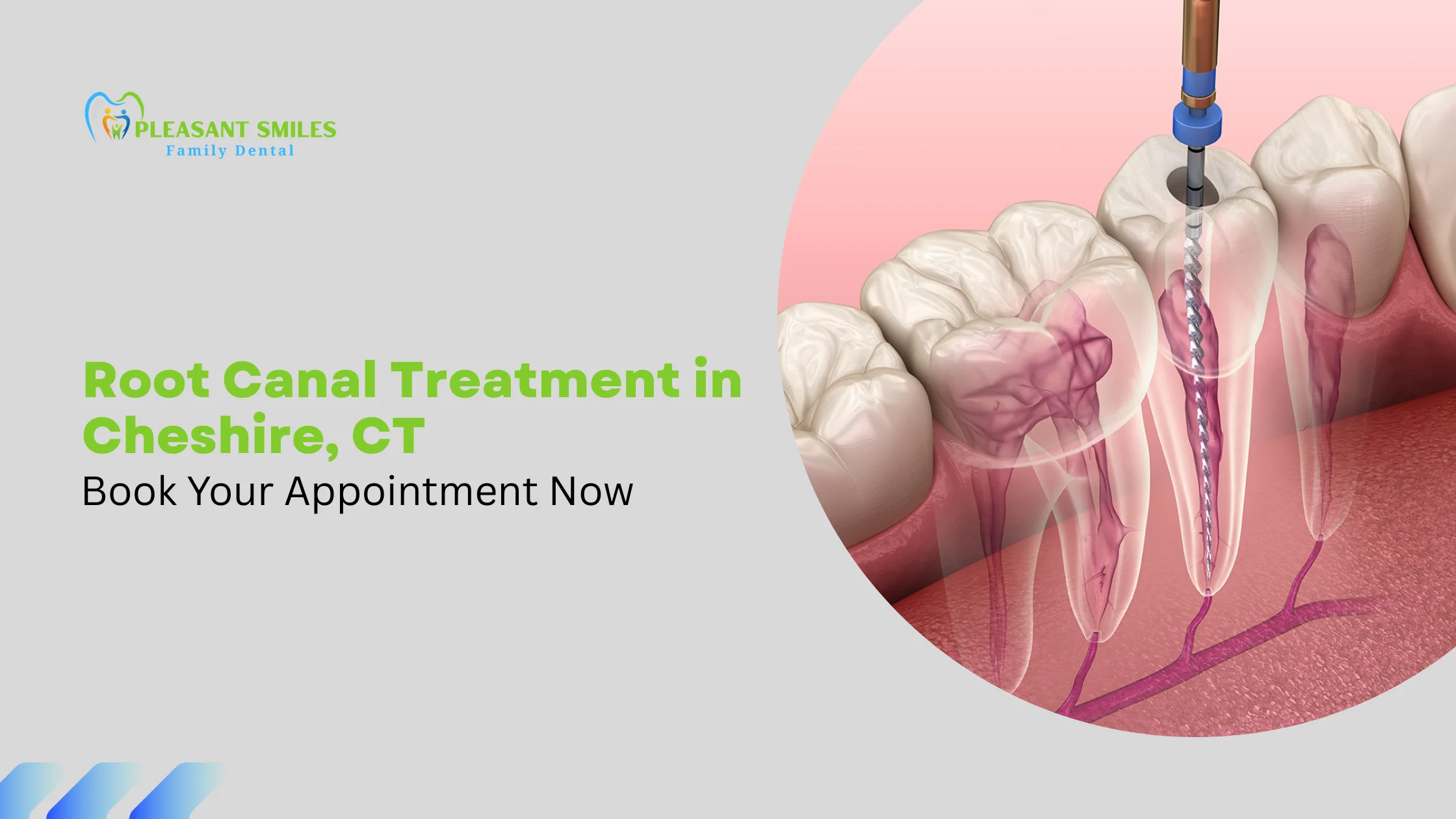 Root Canal Treatment in Cheshire, CT