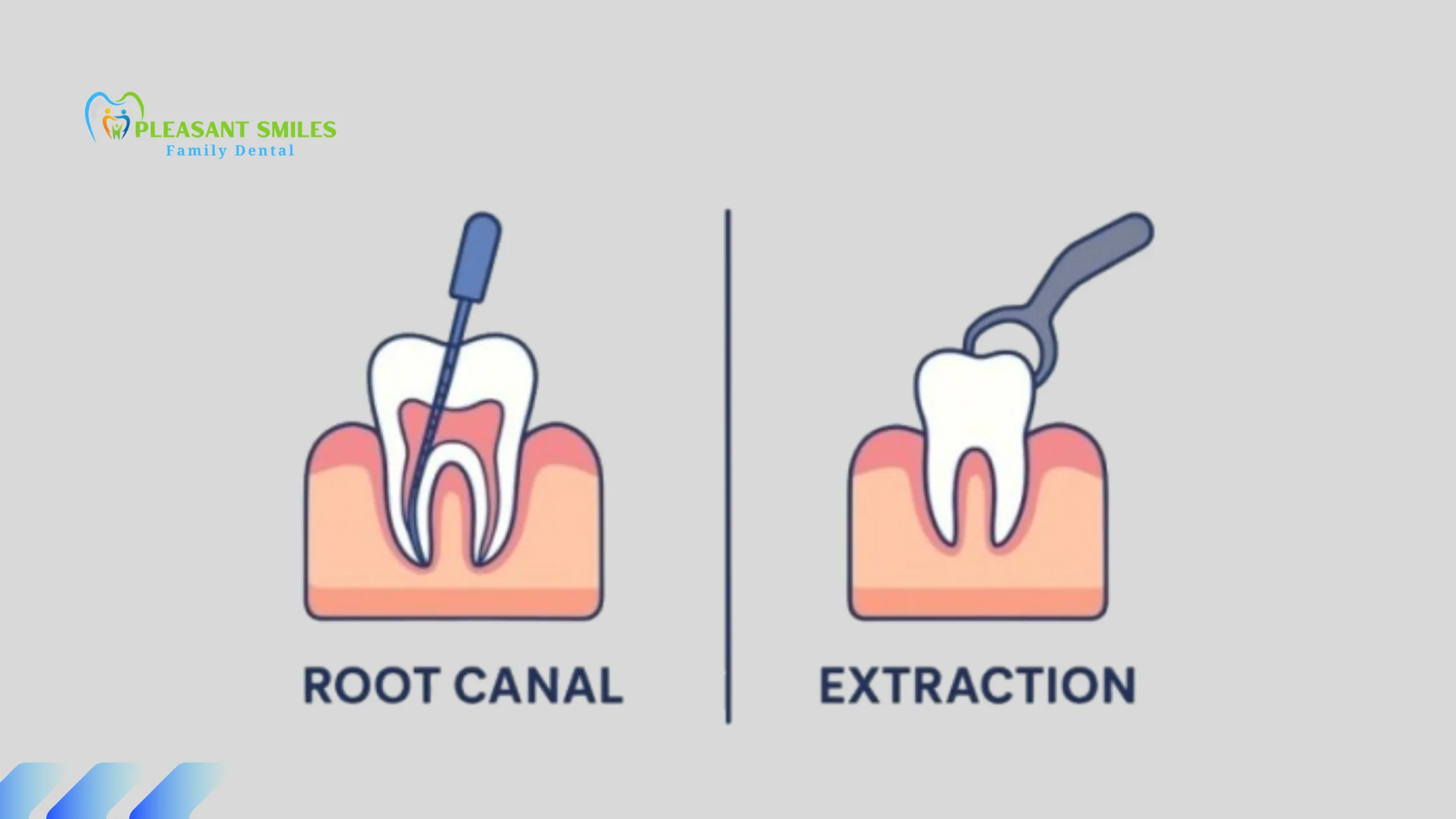 Root Canal vs Extraction