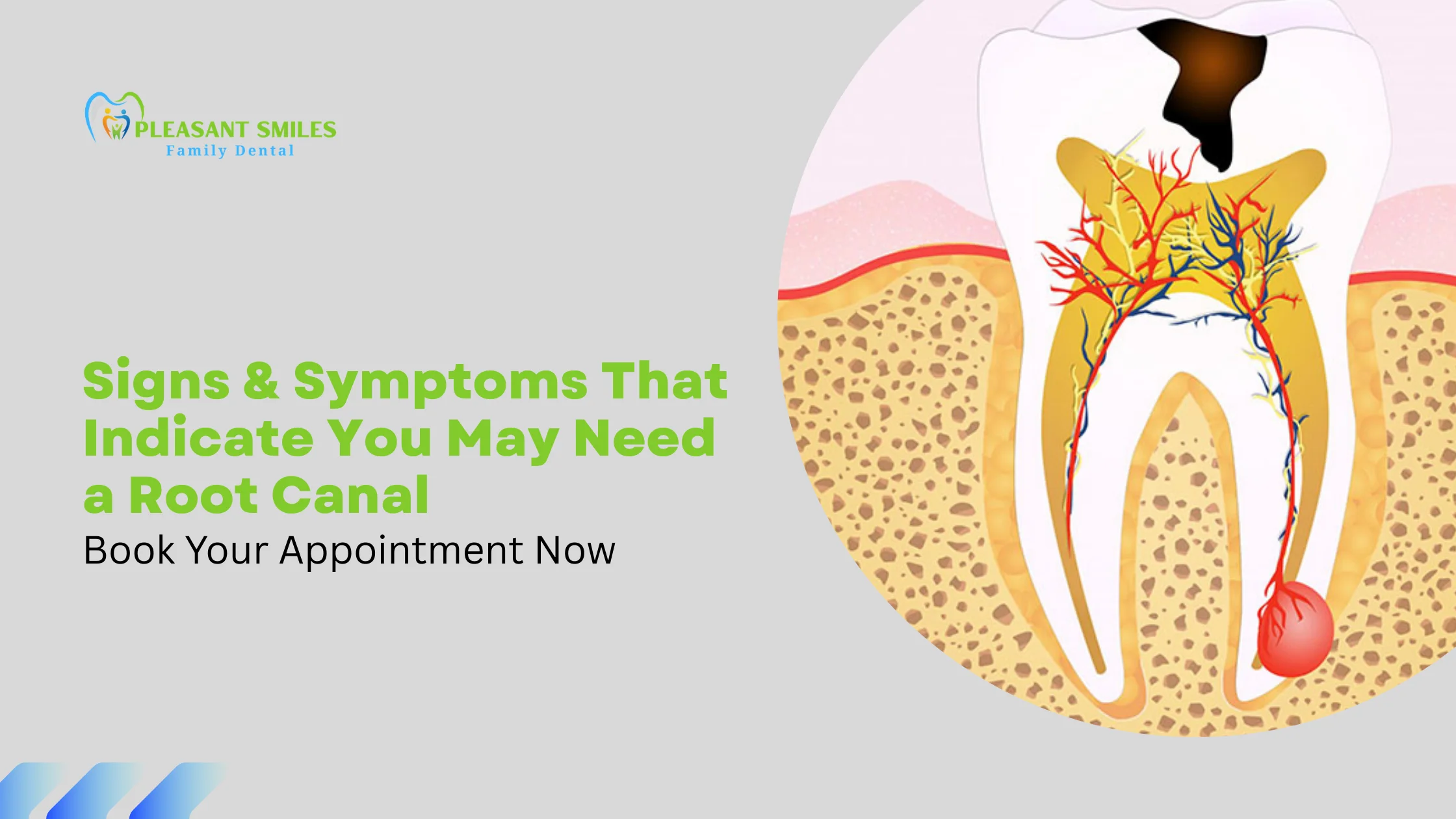 Signs & Symptoms That Indicate You May Need a Root Canal