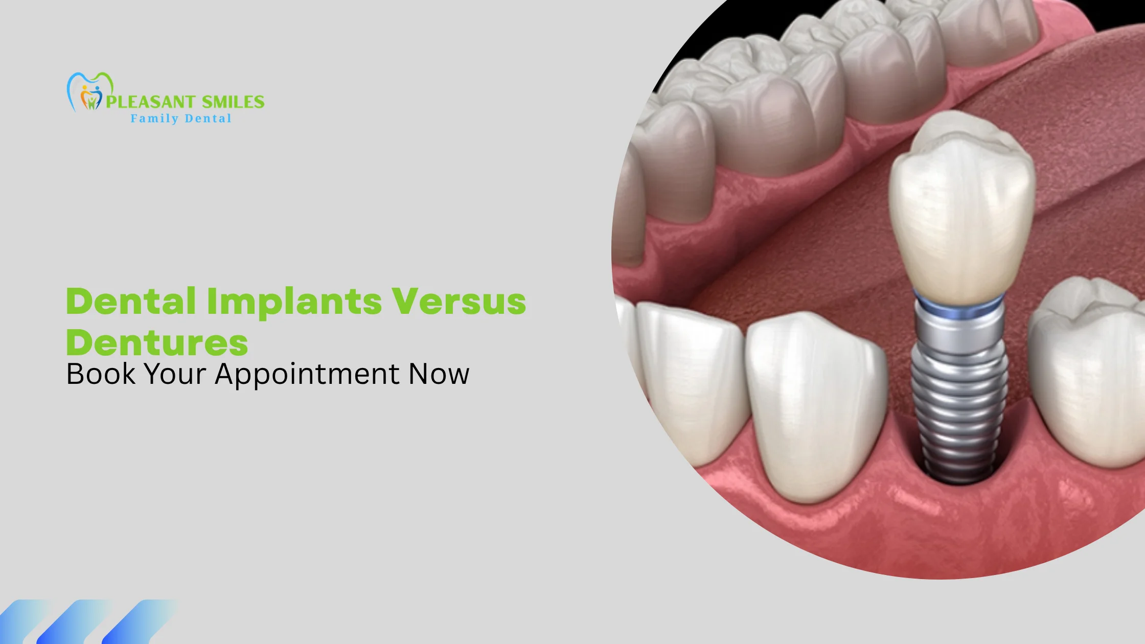 Dental Implants Versus Dentures