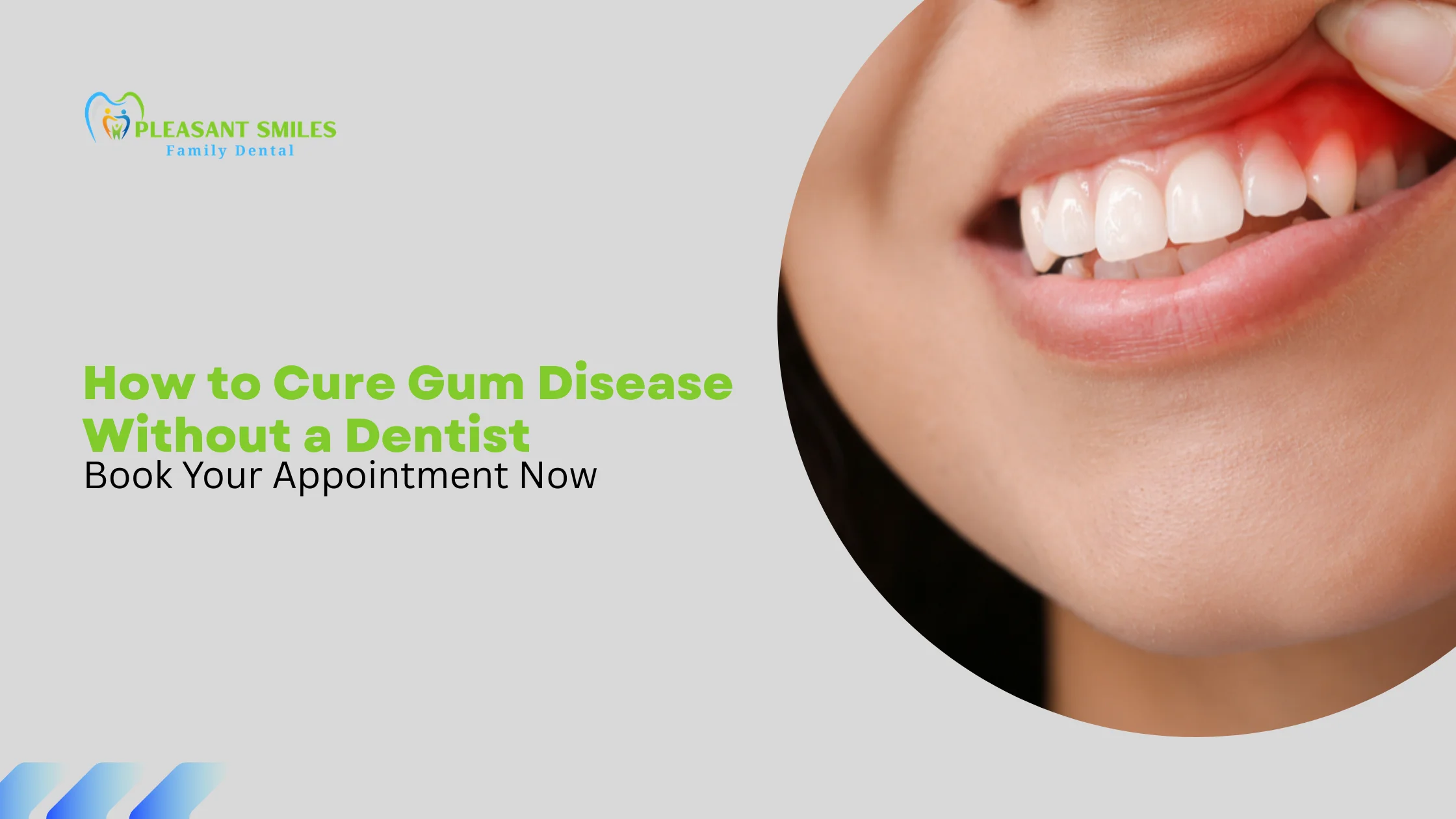 How to Cure Gum Disease Without a Dentist
