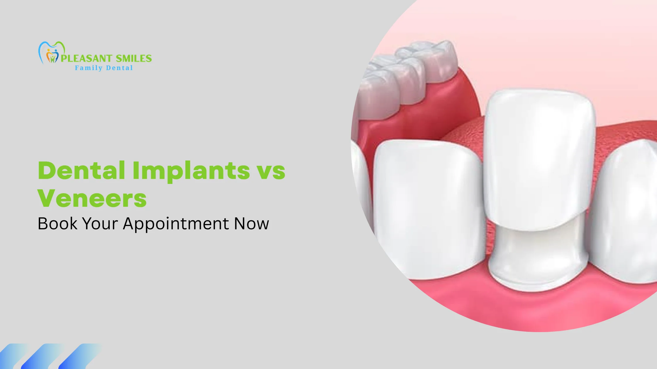 Dental Implants vs Veneers