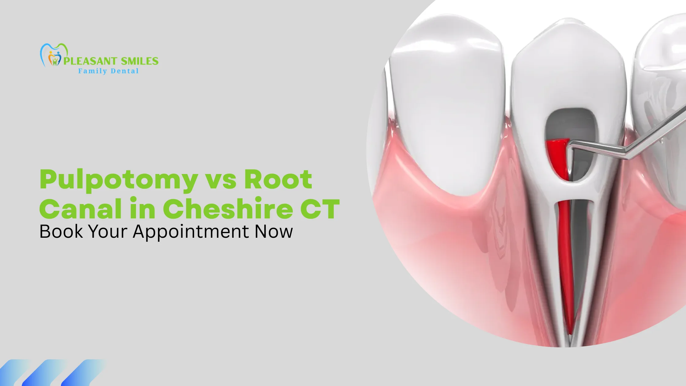 Pulpotomy vs Root Canal