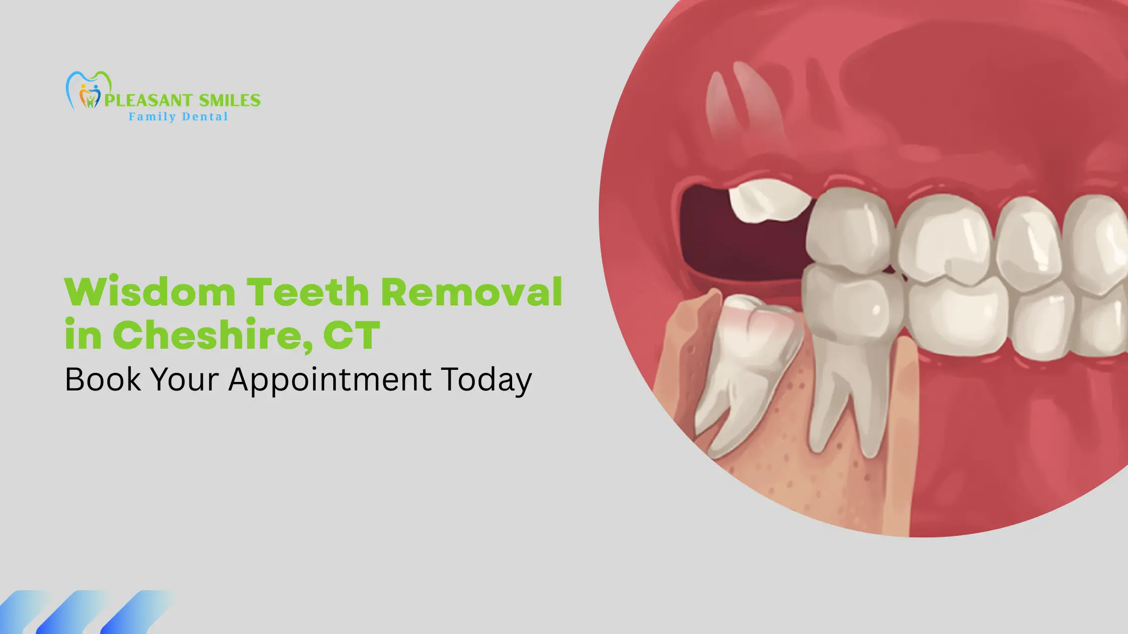 Wisdom Teeth Removal in Cheshire, CT: Trusted Dentists