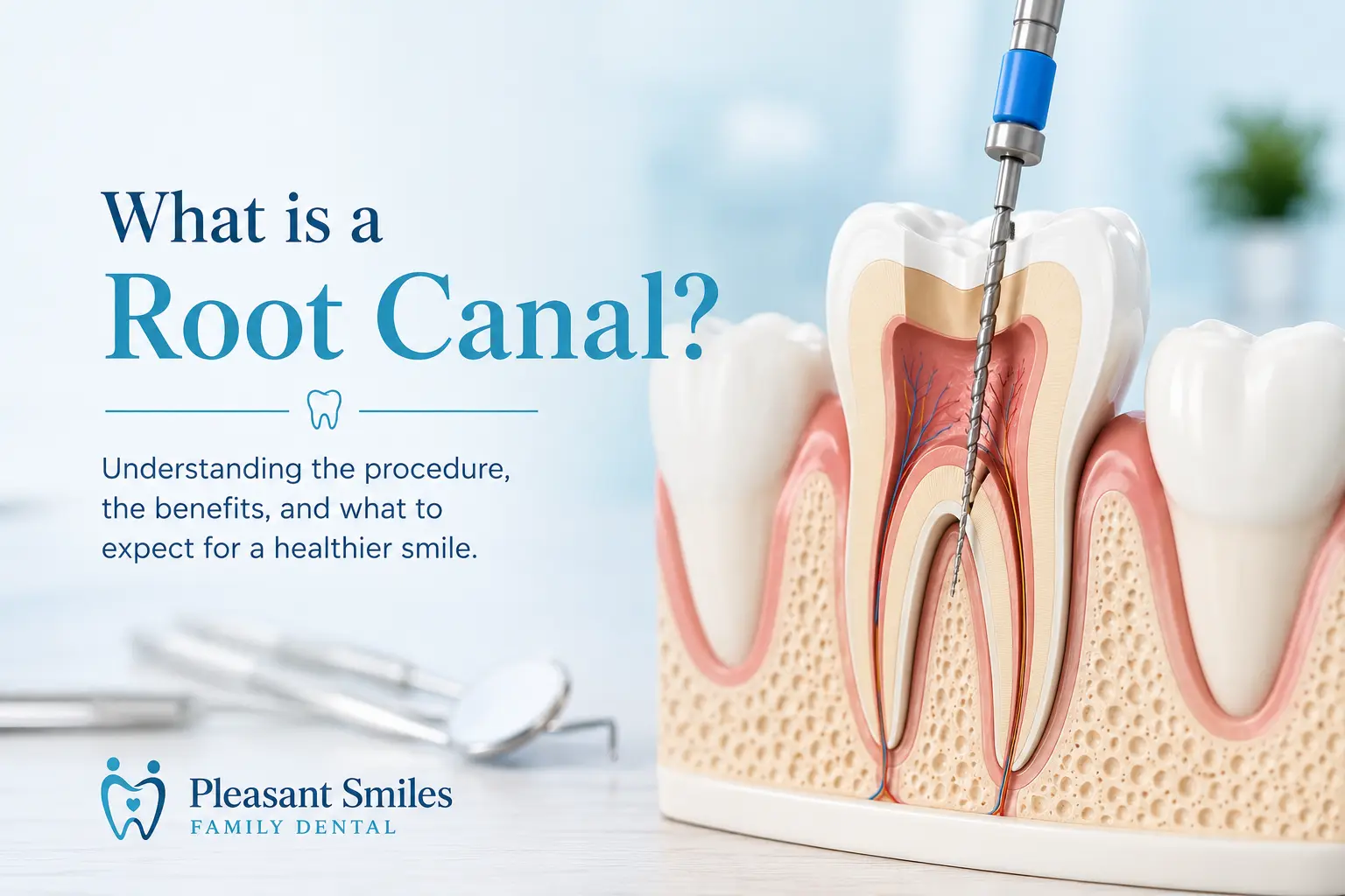 What is a Root Canal?